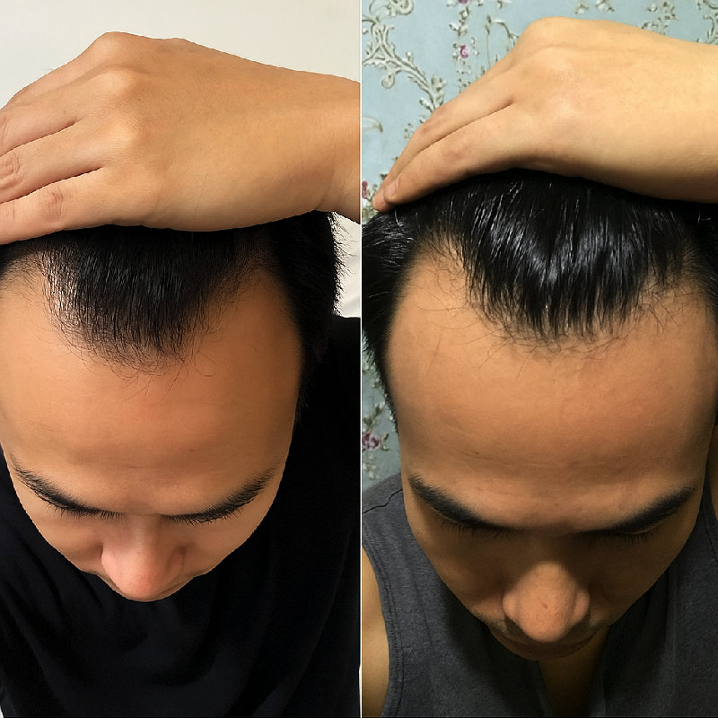 为了应对发际线后退问题，他开始使用一种特殊的洗发水。